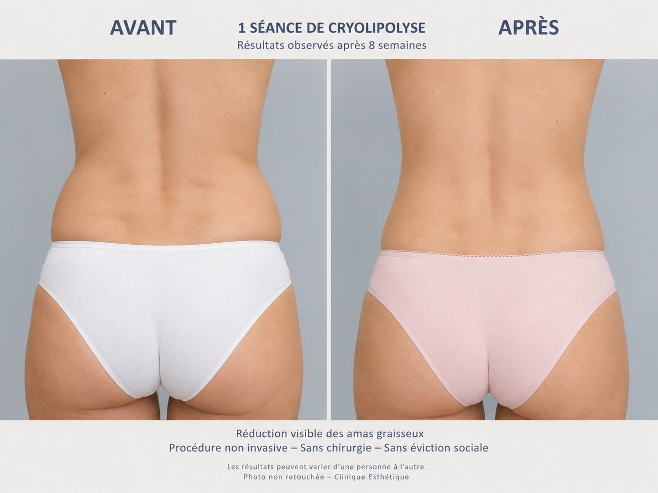 Cryolipolyse avant après taille dos Nice — résultats