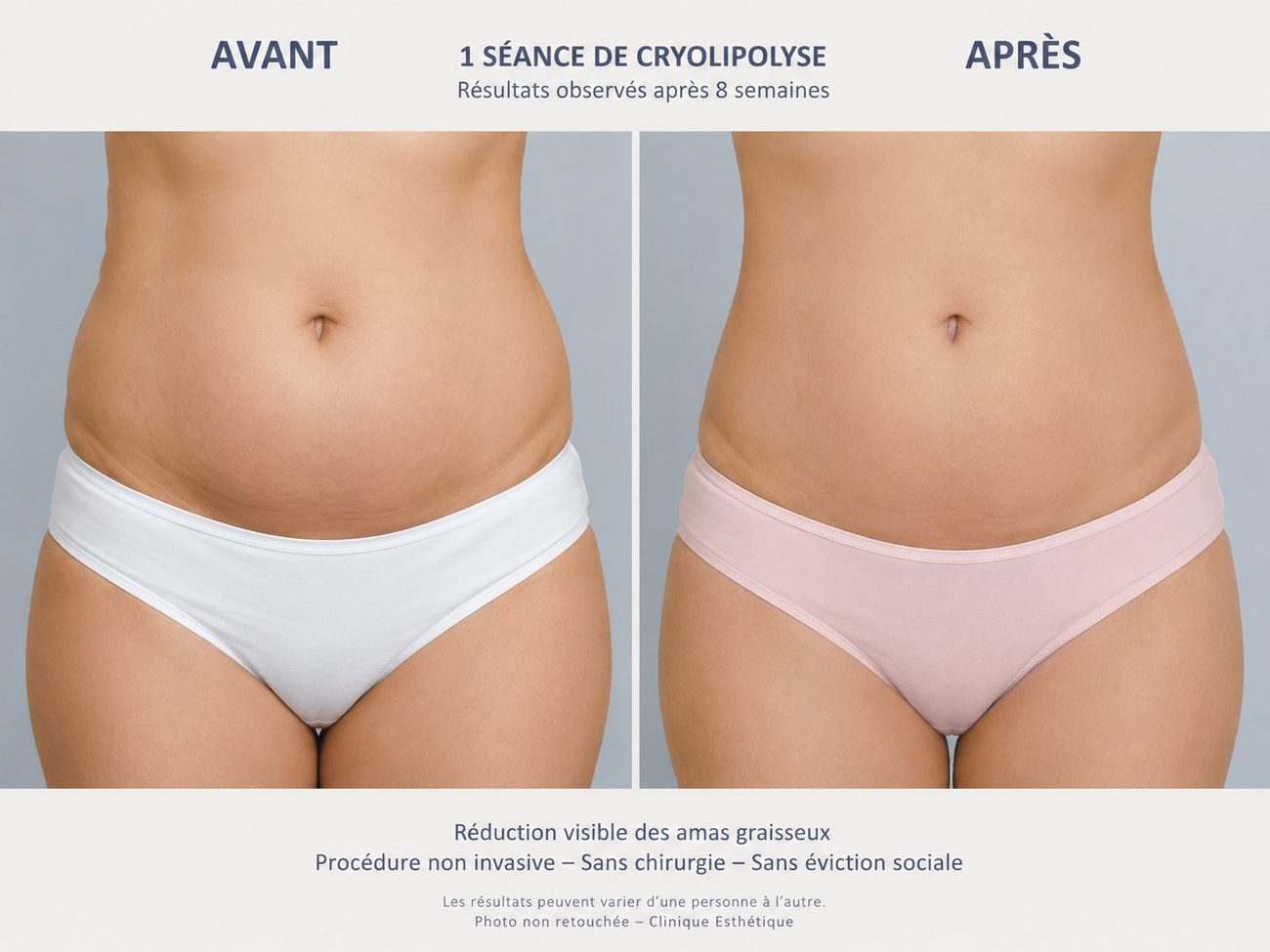 Cryolipolyse avant après ventre Nice — résultats 1 séance